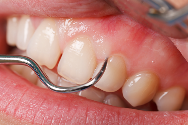 treatment for gum infection