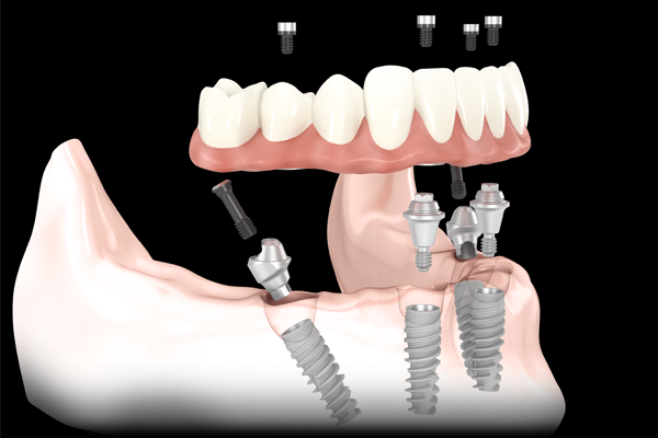 Implant bridge procedure
