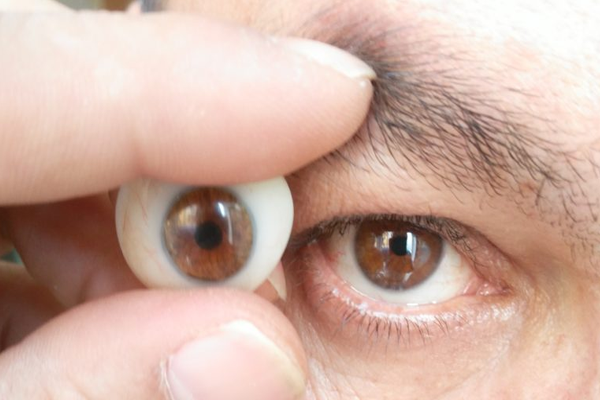 Ocular Prothesis