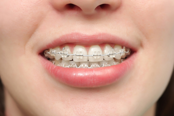 dental braces