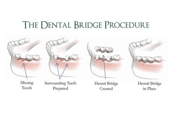 the dental bridge procedure