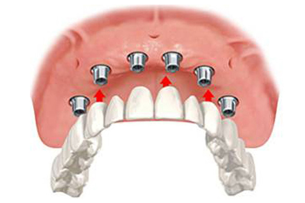 dental implant prosthesis