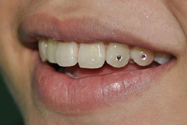 dental jewellery