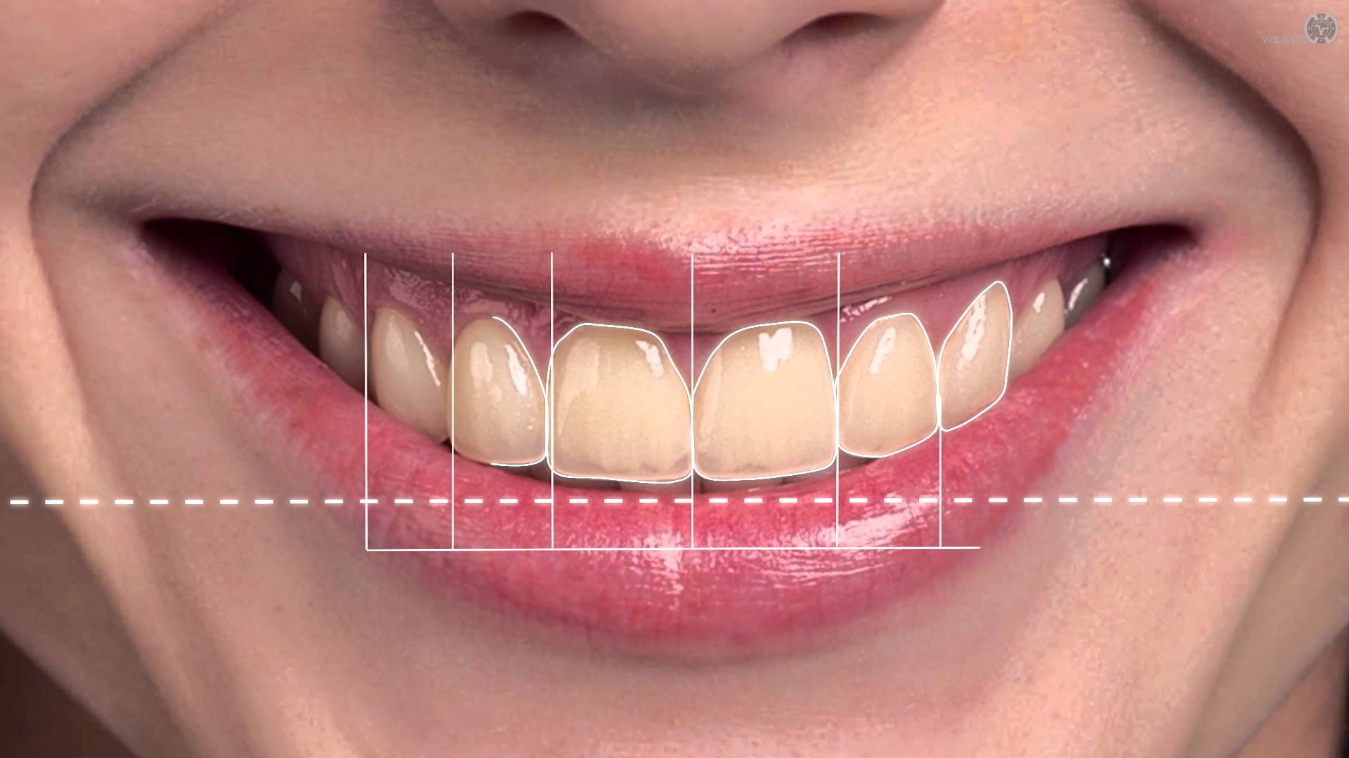 digital smile design