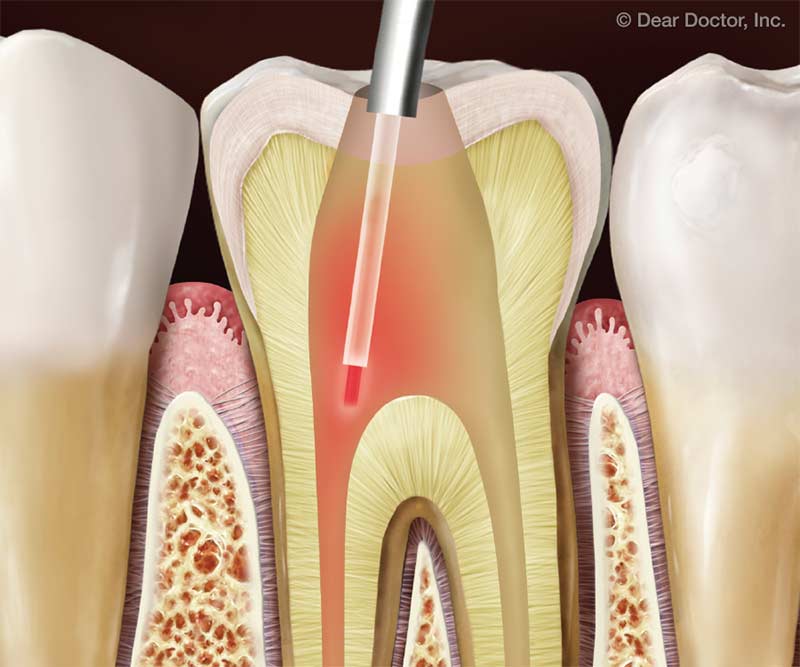 laser root canal treatment