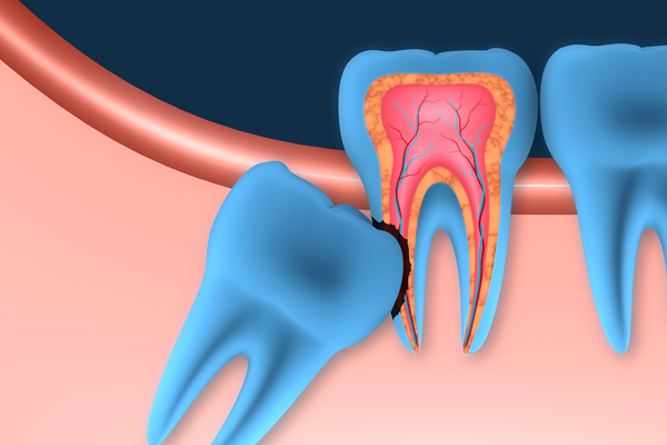 treatment for wisidom teeth